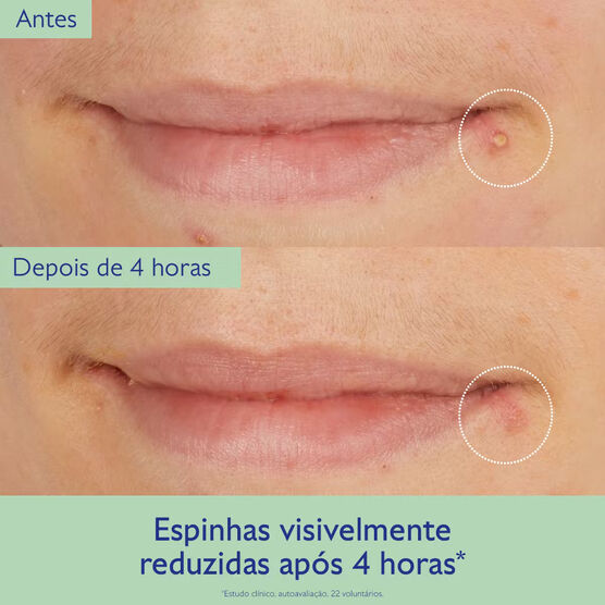 Solu&ccedil;&atilde;o Secativa Salic&iacute;lica Caudalie Vinopure